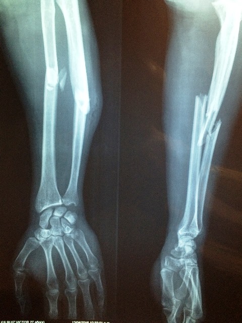 Poor bone health from being severely underweight